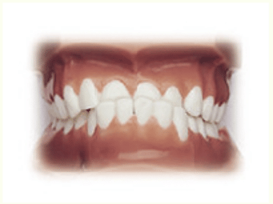 diagram of class two malocclusion