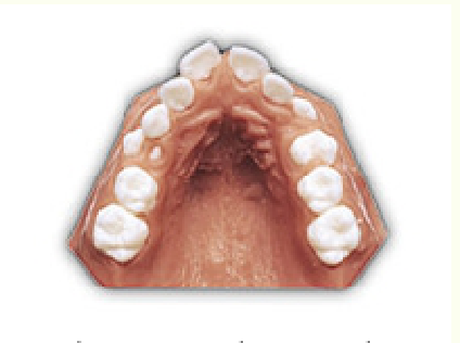 diagram of teeth spacing