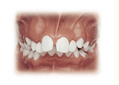 Image of a bite with a malocclusion prior to recieving orthodontic treatment