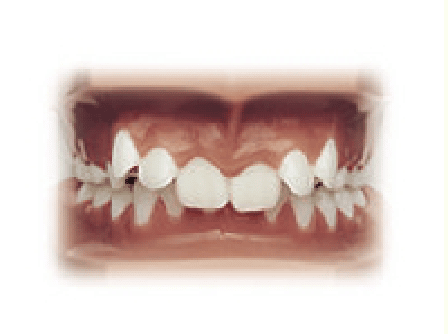 An image of a mouth with teeth missing.