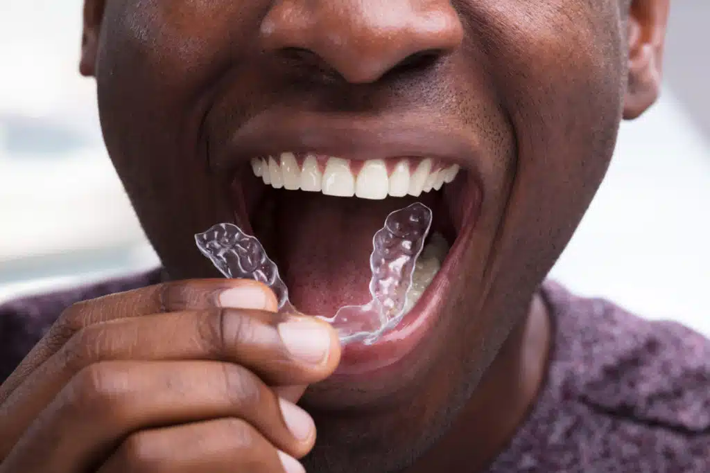 a front view of a man inserting invisalign clear aligners in his mouth
