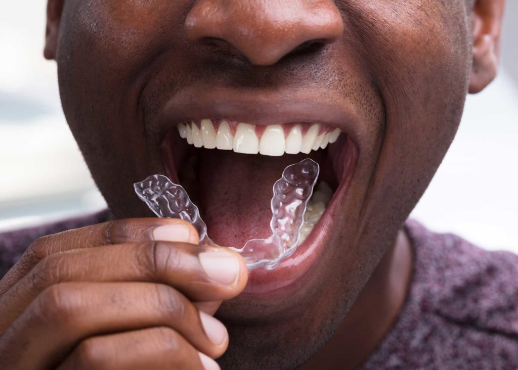 the front view of a man removing his removable retainer