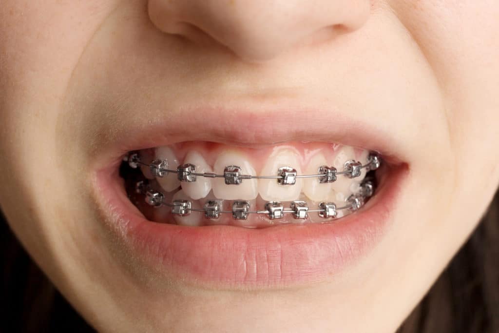 A woman with braces on her teeth.