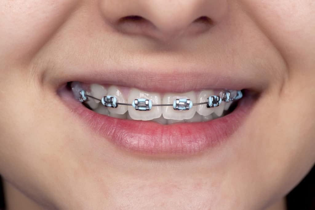 A woman smiles with braces on her teeth.
