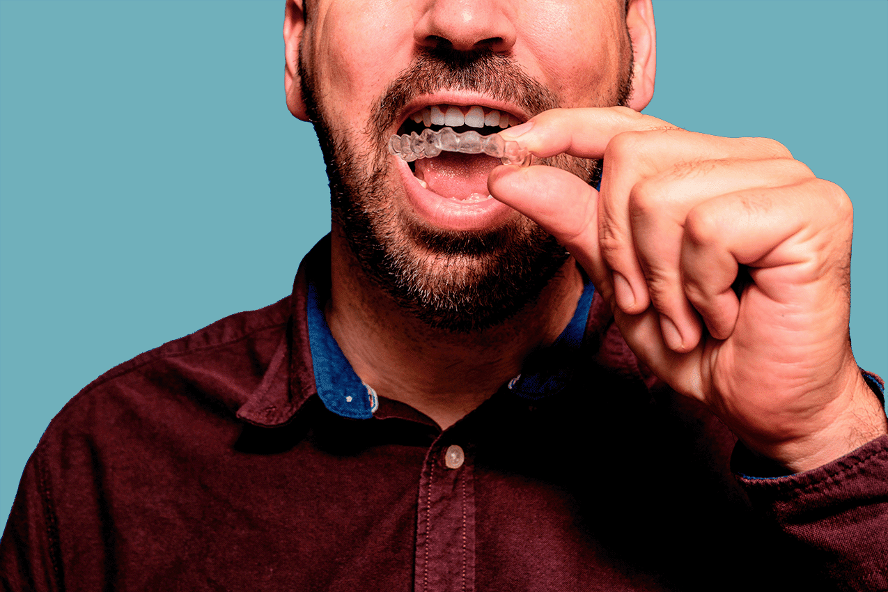 a male with beard inserting invisalign clear aligners in his mouth