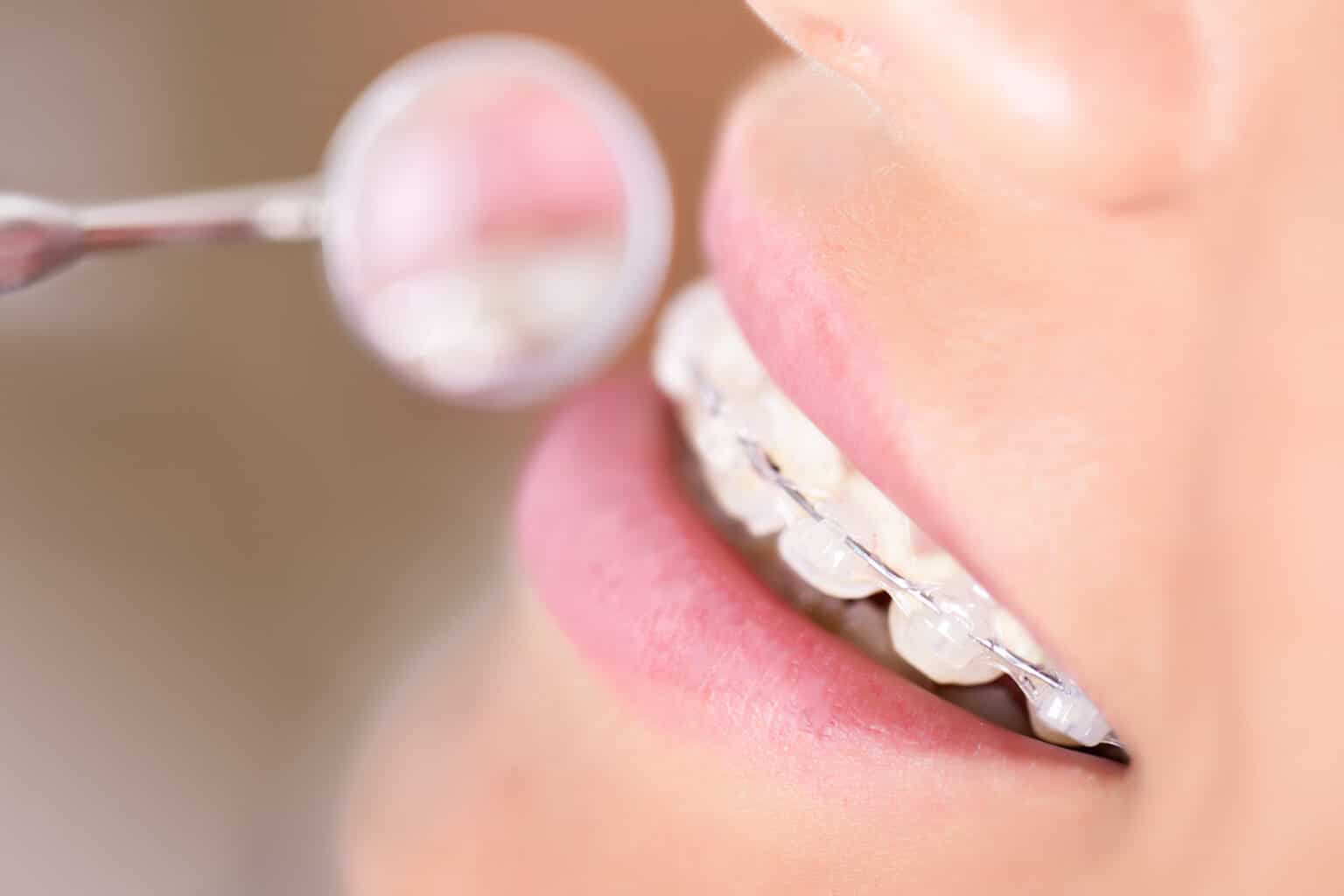 Close-up of the clear braces on a woman at Mary Cay Koen Orthodontics.