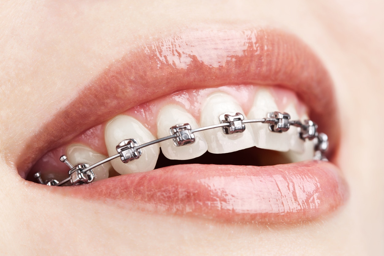 Close-up of a smile with advanced Norris Braces in Nashville, TN.