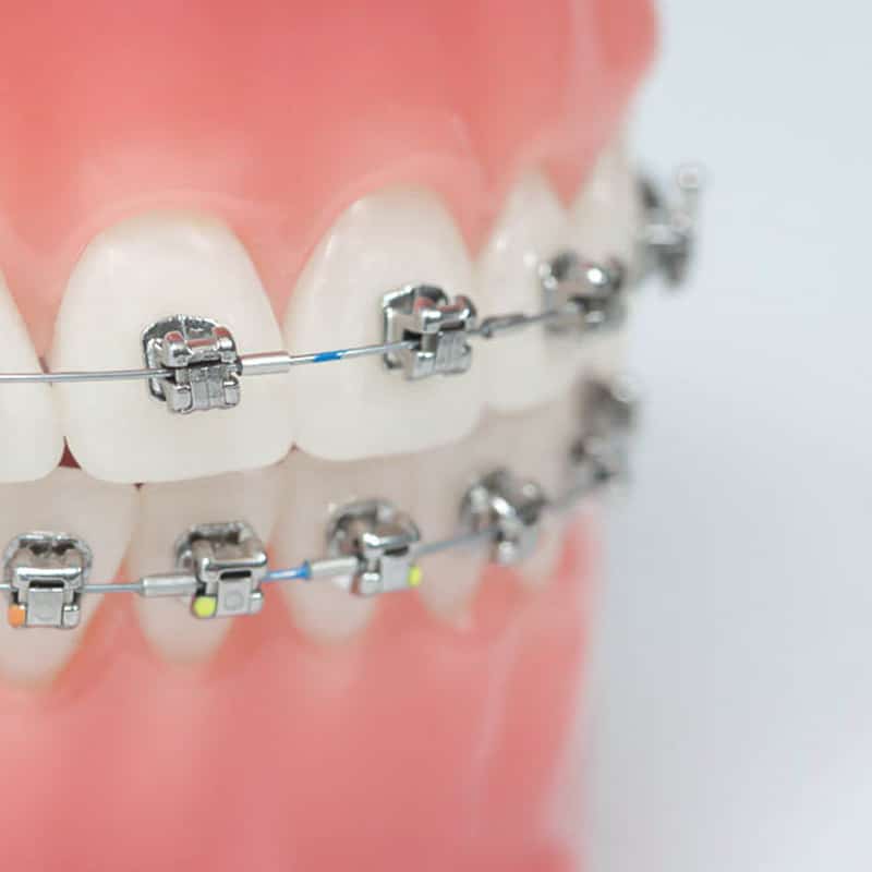 Close-up of a dental model with multi-colored self-ligating braces in Nashville, TN.