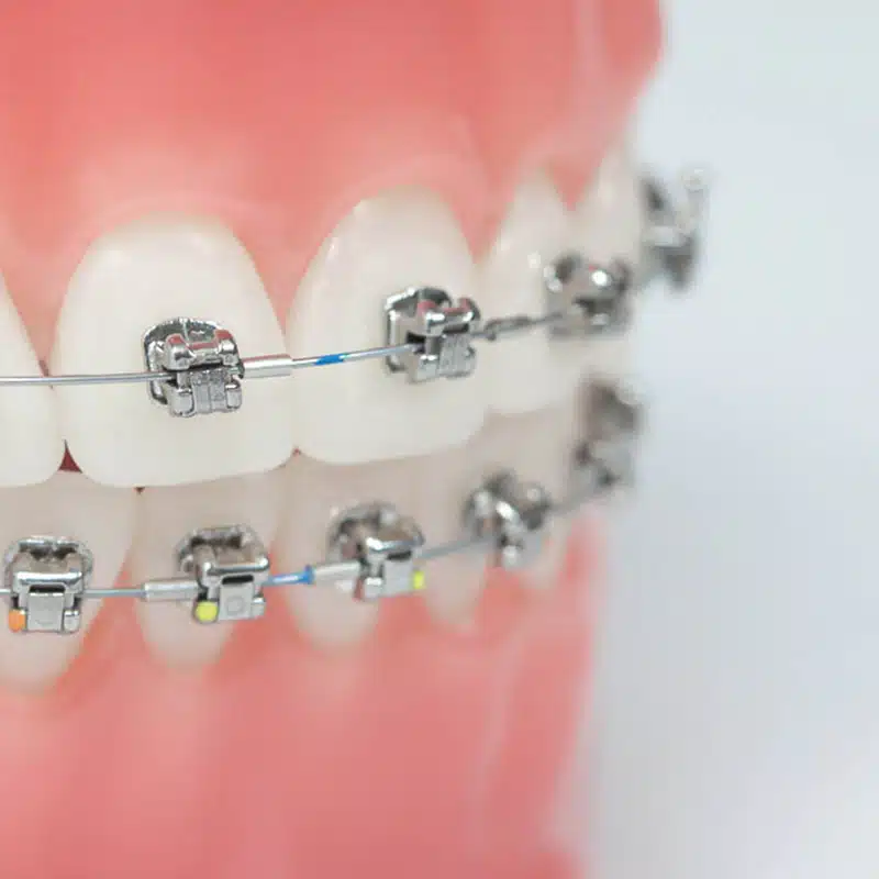 Close-up of a dental model with multi-colored self-ligating braces in Nashville, TN.