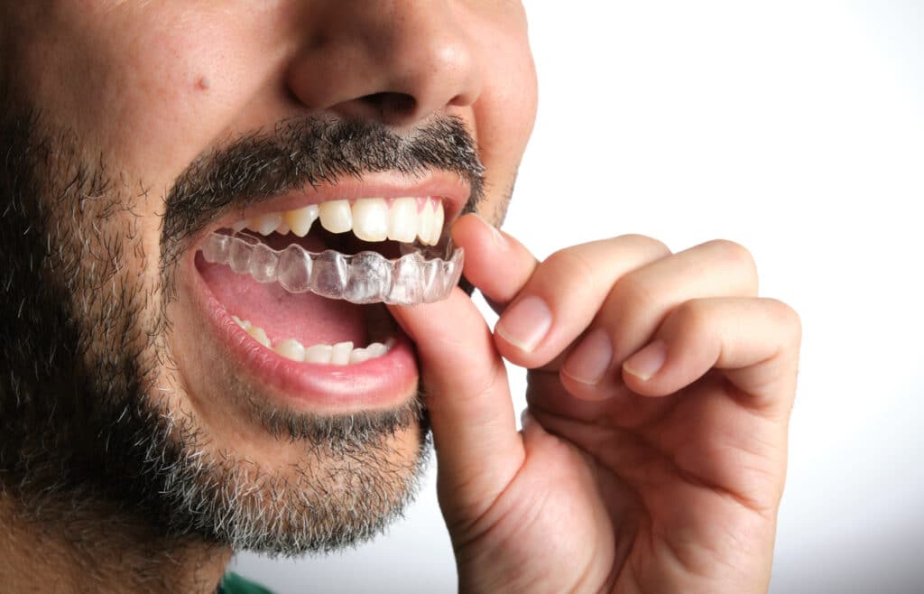 Man with clear aligners in Nashville, TN and a salt and pepper mustache putting an aligner in