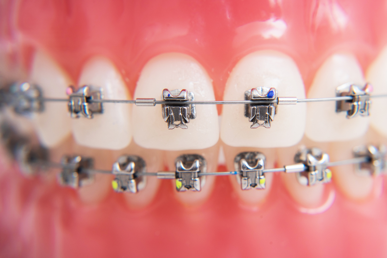 On Macro Photos Shows How The System Of Brackets Is Arranged