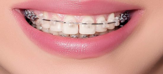 Closeup Ceramic and Metal Braces on Teeth. Beautiful Female Smile with Brackets. Orthodontic Treatment.