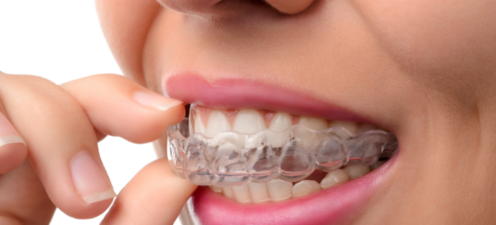 Woman putting in Invisalign system clear aligners