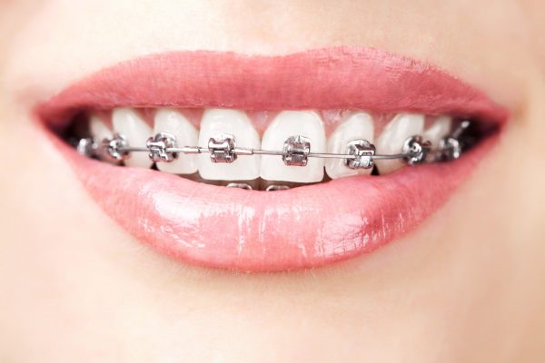 teeth with damon braces
