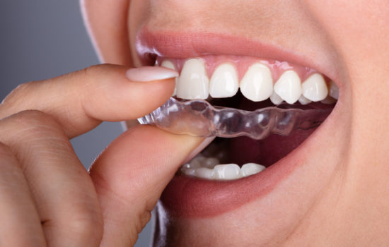 Close-up,Of,A,Woman's,Hand,Putting,Transparent,Aligner,In,Teeth