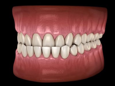 Underbite dental occlusion ( Malocclusion of teeth ). Medically accurate tooth 3D illustration